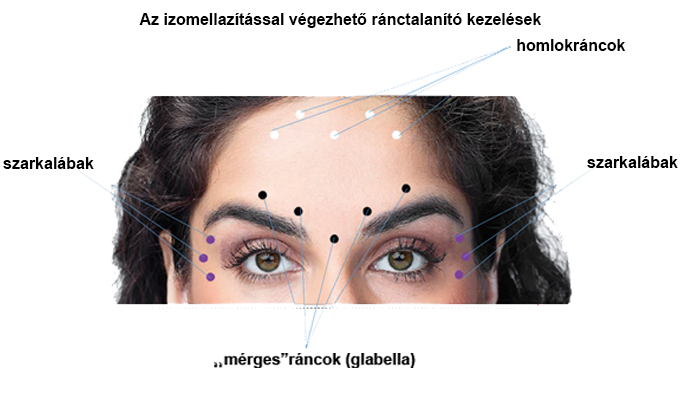 Rnctalant kezels izom ellaztssal